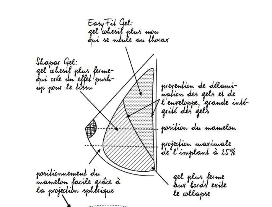 Implant-mammaire-nouvelle-génération